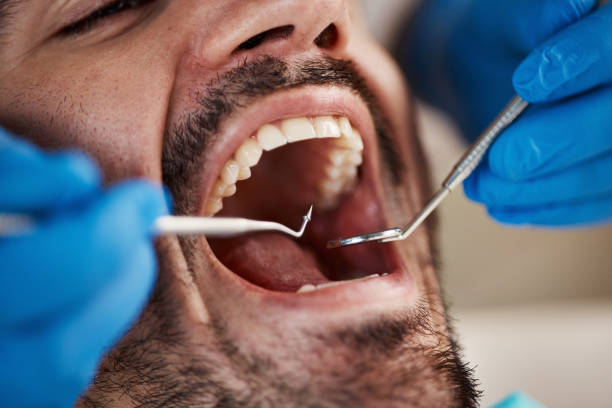 Best Emergency Root Canal Treatment in Russiaville, IN